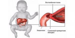 Пороки развития желудочно-кишечного тракта у новорожденного